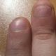 Как да се лекува онихолиза на ноктите