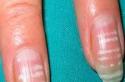 Почему появляются белые пятна на ногтях рук и ног и что они означают?