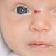 Flekker på et barns kropp Pigmentflekker i ansiktet forårsaker hos barn