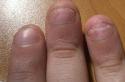 Як лікувати оніхолізис нігтів