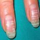 Чому з'являються білі плями на нігтях рук та ніг і що вони означають?